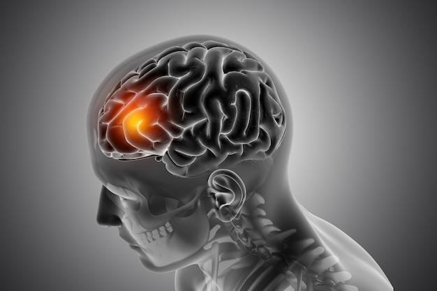 НГДоктор | Что такое киста шишковидной железы в головном мозге