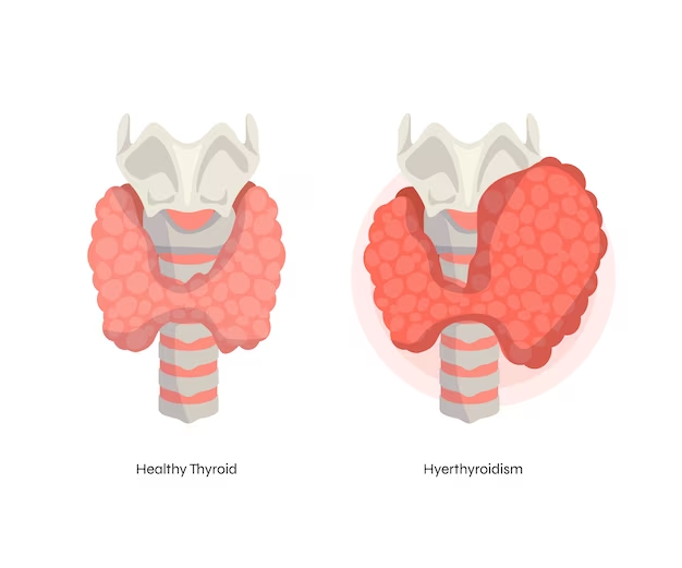 Изображение злокачественных новообразований щитовидной железы - симптомы, диагностика и лечение